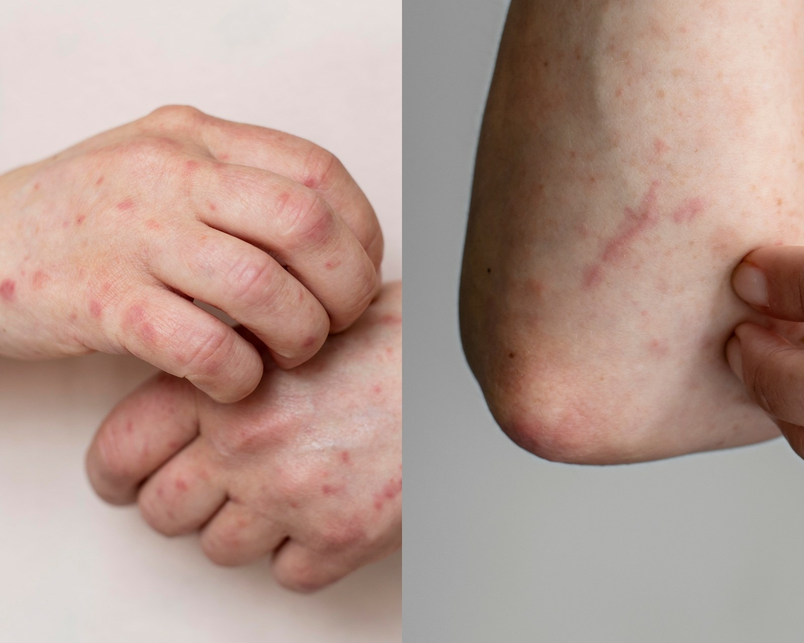 So zeigen sich die kleinen Spinnentiere und ihre Auswirkungen bei uns auf der Haut. | ©FREEPIK